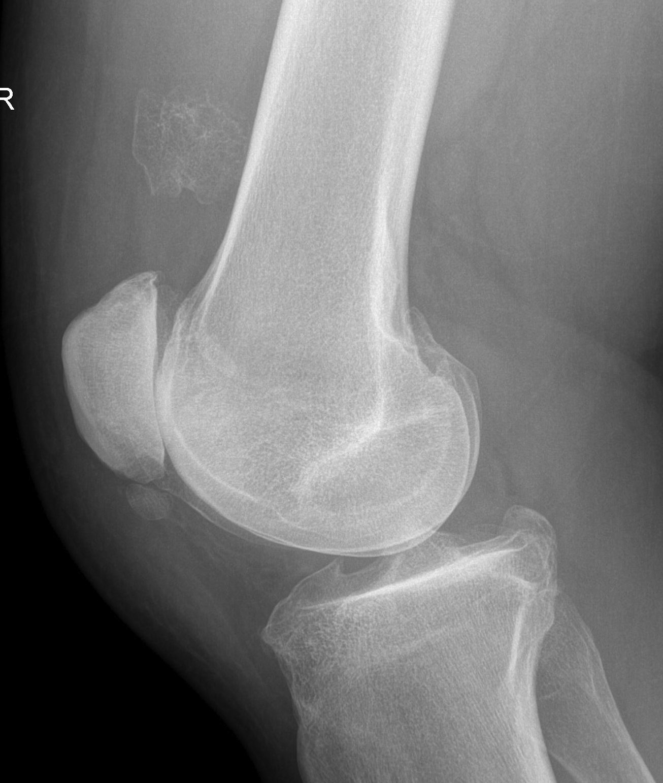 Myositis Ossificans Quadriceps